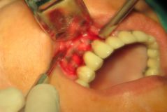 Peri-Implantitis workshop 2015