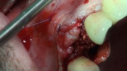 4-5-Mehr-98-Live-Surgery_9