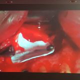 Immediate implementation and immediate loading_14