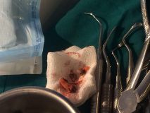 دوره آموزشي سينوس ليفت همراه با جراحي زنده