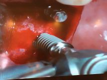 SPI system presentation with live surgery_8