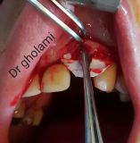 SPI system presentation with live surgery_18