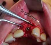 معرفی سیستم SPI همراه با جراحی زنده و Immediate Loading - آبان ۹۵