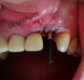 SPI system presentation with live surgery_22