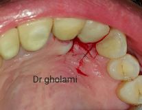 معرفی سیستم SPI همراه با جراحی زنده و Immediate Loading - آبان ۹۵