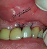 SPI system presentation with live surgery_25