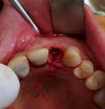 SPI system presentation with live surgery_8